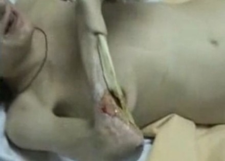 Posledice droge "krokodil"