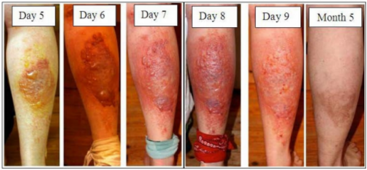 55f9d5fa-065c-468e-9cdb-517e0a0a0a6c-hogweed-sap-injuries-e1309990898846-previewOrg