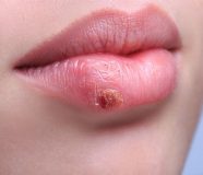 HERPES