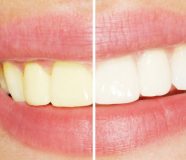 zubi
